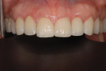 Fig 12. After a loading time of 8 weeks, the all-zirconia abutment was inserted with the assistance of an insertion guide. The final restorations were then seated and inserted.