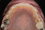 Fig 2. Occlusal view showing fractured cusps and severe acid erosion of the maxillary dentition. Note that the canal chamber was visible on teeth Nos. 6 through 11.
