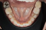Fig 3. The mandibular arch presented in fine shape, except for cervical decay and the need for endodontic therapy on tooth No. 31.