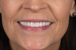 Fig 11. Nearly 3 months after the initial appointment, the patient’s smile featured beautiful and functional teeth. Note the healthy tissue and exceptional healing due to proper planning, crown lengthening, and crown fabrication by the MicroDental lab team. The shade and shape of the restorations fit the smile.