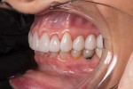 Fig 10. For the delivery appointment, the temporaries were carefully removed and the teeth treated with desensitizer (MicroPrime™, Zest Dental Solutions, zestdent.com). With healthy tissue and a comfortable vertical dimension established, the front six restorations were placed first, followed by the posterior. The laboratory team crafted the occlusion such that very little adjustment was necessary for stability and functionality.