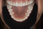 Fig 12. Nearly 3 months after the initial appointment, the patient’s smile featured beautiful and functional teeth. Note the healthy tissue and exceptional healing due to proper planning, crown lengthening, and crown fabrication by the MicroDental lab team. The shade and shape of the restorations fit the smile.