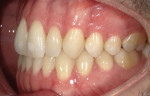 Fig 8. Preoperative photographs may also include buccal and frontal retracted views together, as shown here, to help patients visualize their dentition. These photos further enabled the patient to see the white spots and misalignment of the teeth from different angles.