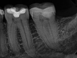 Fig 1. In the initial pre-procedure radiograph, the anatomical complexity within the root canal system of this C-shaped molar was not immediately apparent.