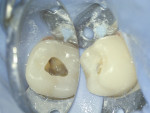 Fig 2. Conservative straight line access was accomplished with a carbide bur (Great White®, SS White, sswhitedental.com), and
access was refined with a football diamond two striper. Note the pulp tissue in the orifices and isthmus. With an apex locator (Apex ID, Kerr, kerrdental.com), the canals were measured at 21.5 mm.