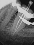 Fig 7. Next, staged cone fit was carried out, as conservative straight line access with minimally invasive canal preparation makes it a challenge to place all gutta-percha (GP) cones at once.