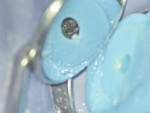 Fig 4. A light-cure conforming resin material (SoundSeal™, Sonendo) along with a molar matrix were used to complete the GentleWave Platform build and ensure that a
sealed environment was retained throughout the procedure.