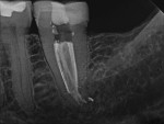 Fig 10. Final radiograph. The pre-procedure radiograph (Fig 1) did not reveal the complexity of this C-shaped molar root canal. The GentleWave Procedure, however, was able to handle tissue dissolution and clean all lateral canals, fins, webbing, isthmus, deltas, anastomosis, and multiple portals of exit. The clinical result was outstanding for both the patient and clinician.