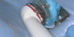 Fig 5. The GentleWave Procedure was then performed. The mechanism of action begins in the GentleWave console where sodium hypochlorite (NaOCl), ethylenediaminetetraacetic acid (EDTA), and distilled water are degassed. These optimized procedure fluids flow through a Procedure Instrument, which rests on the SoundSeal platform, and into the root canal chamber. The procedure was completed in 8 minutes.