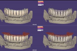 Fig 9. STL files after digital scanning of the titanium framework and imported into CAD software for design of the single crowns.