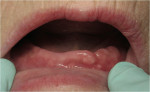 Figure 1  The patient had been wearing a lower denture for 4 months prior to seeking implant treatment.