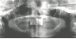 Figure 2  A preoperative panoramic radiograph showed adequate bone width for MDIs.