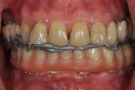 Fig 4. Interocclusal record of provisional restoration against opposing arch using bite registration wax.