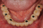 Fig 11. Occlusal view of definitive prosthesis.