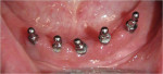 Figure 3  Five implants were placed in the mandible.