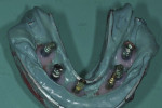 Fig 7. Soft-tissue mask syringed around the implant analog and impression coping junction.