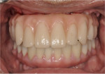 Fig 15. Maxillary provisional restoration against mandibular definitive restoration.