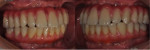 Fig 16. Upper and lower definitive screw-retained restorations.