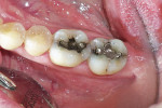 Figure 1  Preoperative view of failed restorations with recurrent caries.