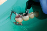 Figure 2  Application of etchant over the entire occlusal surface of tooth No. 31.