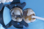 With the amalgam removed, a matrix helps
shape the distal aspect of the tooth as the
composite core buildup material is applied and
light-cured.