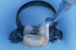 Excess enamel is removed at the margin to
ensure a complete seal.