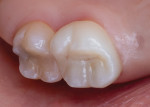 Posttreatment photograph showing seated zirconia crown on tooth No. 3 and direct composite restoration of tooth No. 2.