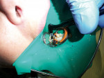 Figure 7  Application of the anti-bacterial self-etch primer to the cut dentin and cut enamel.