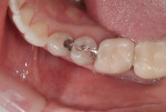 Preoperative photograph of tooth No. 20, prior to the removal of the existing amalgam restoration and decay.