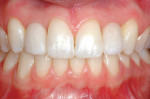 Figure 13  Retracted frontal view 1-year postimplant.