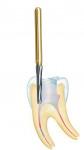 Figure 2  An endodontic carbide improves a practitioner’s vision into the canal.