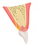 Fig 3. Diagram showing the initial internal bevel palatal incision and the sulcular incision.
Note that the tissue to be excised is still attached to the palatal alveolar bone.