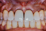 Fig 7. Buccal view after suturing. Sutures did not pass through buccal tissue in this case.