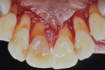 Fig 10. Palatal flap was elevated using the papillary retention design. The buccal flap and papillae were not elevated.