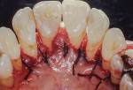 Fig 12. The knots of the sutures were placed palatally to avoid further cosmetic compromise during healing. Silk sutures were used in this case, but the authors recommend 5-0 or 6-0 ePTFE or polyglactin sutures for periodontal surgery to prevent bacterial wicking.