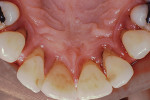 Fig 14. Palatal view at initial presentation (Fig 14) and 3 years post-surgery (Fig 15). At initial presentation, note heavy calculus, gingival inflammation, rolled gingival margin, and palatal gingival recession. At 3 years post-surgery, note the improved gingival health and maintenance of the interproximal papillae with apical positioning of the palatal tissues.
