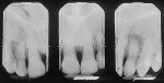 Fig 17. Initial radiographs revealed 30% to 40% attachment loss present interproximally.