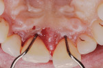 Fig 18. Severe palatal probing (up to 7 mm to 8 mm) remained following nonsurgical therapy. A papillary retention procedure was planned in the maxillary anterior sextant.