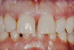Fig 16. This patient presented with generalized severe periodontitis that was associated with mobility, diastema formation, and buccal flaring.