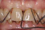 Fig 21. Thirty-one years later, periodontal stability was maintained, and the interproximal pocket depths probed 2 mm to 3 mm.