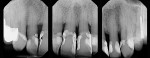 Fig 24. Radiographs taken 28 years later revealed bone-level stability and maintenance of all maxillary anterior teeth. One posterior tooth was extracted due to endodontic failure.