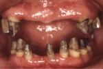 Fig 9. Clinical view of patient in Case 2 after periodontal surgery.