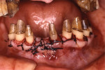 Fig 8. Clinical view of patient in Case 2 during periodontal surgery. After the initial debridement therapy, definitive periodontal surgery was performed, including pocket elimination, osseous surgery, and resectioning of a mesial-buccal root due to furcation invasion of the first molar.