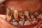 Fig 17. Patient in Case 3 during definitive periodontal surgery, which included placement of free gingival graft.