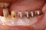 Fig 18. Patient in Case 3 after definitive periodontal surgery, showing that nice, wide bands of attached gingiva were established.