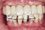 Fig 10. Patient in Case 2 during
orthodontic treatment, which was provided
with the provisional restoration to
improve the occlusal plane.