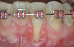 Fig 1. Clinical photograph of tooth No. 23 showed significant recession, a buccal plate deficiency, root prominence, and a thin periodontium.