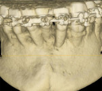 Fig 2. CBCT taken for risk assessment at the initiation of orthodontic treatment. 3D rendering showed limited buccal bone in general and no buccal plate for most of tooth No. 23.