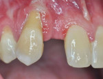 Fig 9. For the patient in the third case discussed, the pretreatment clinical photograph showed significant recession, root prominence, and a thin tissue phenotype for tooth No. 6 and limited space and root convergence for proposed implant No. 7.