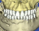 Fig 8. Treatment planning model (Fig 7) and proposed final treatment (Fig 8). Note the improved buccal plate thickness in numerous areas. The right side of the mouth had surgically facilitated orthodontic therapy, and the improved buccal plate dimension is evident with orthodontic treatment
to reduce root prominence.